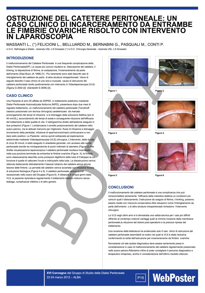 disostruzione laparoscopica di catetere per dialisi peritoneale